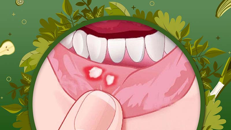 How to Treat Canker Sores