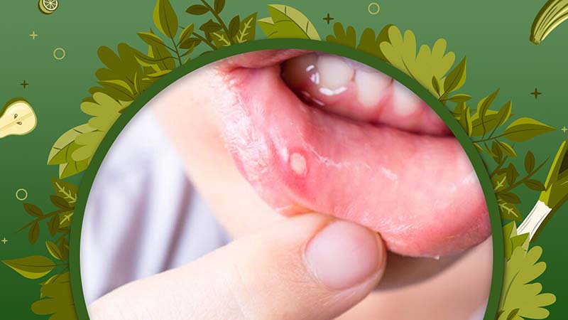 How to Treat Canker Sores with Amaranth